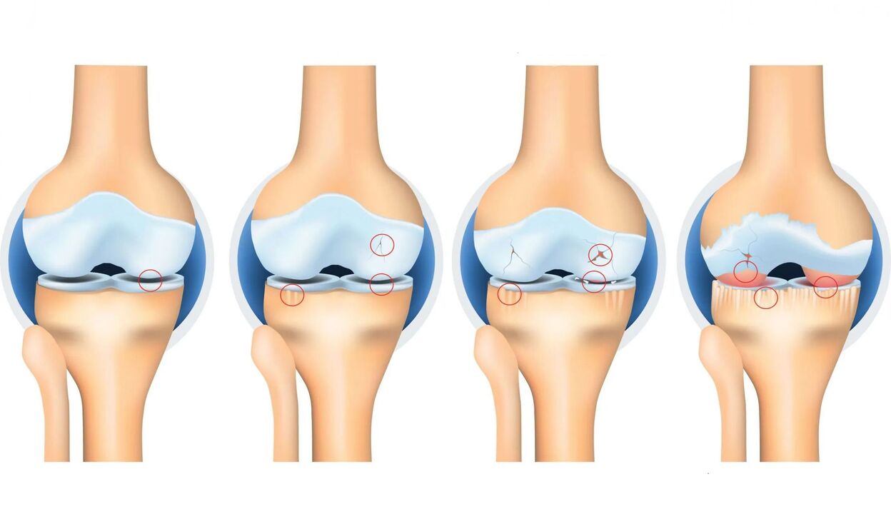 ízületi arthrosis